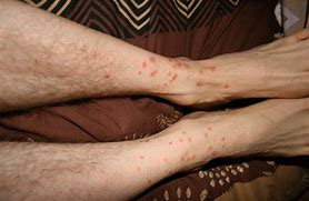 morsures de puce sur les jambes