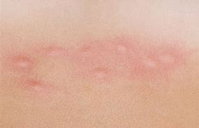 piqures de punaises de lit