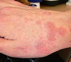 eczéma de gale sur la main